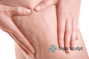 CoolSculpting for Legs: The Innovative Approach to Redefining Your Legs 5 Start your journey today book your coolsculpting treatment Salford Priors online today!