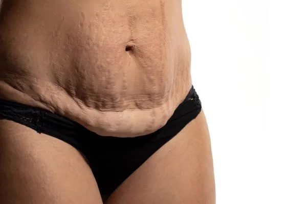 Lost the Weight but Not the Loose Skin? 1 image of womans stomach after weight loss showing loose skin Salford Priors